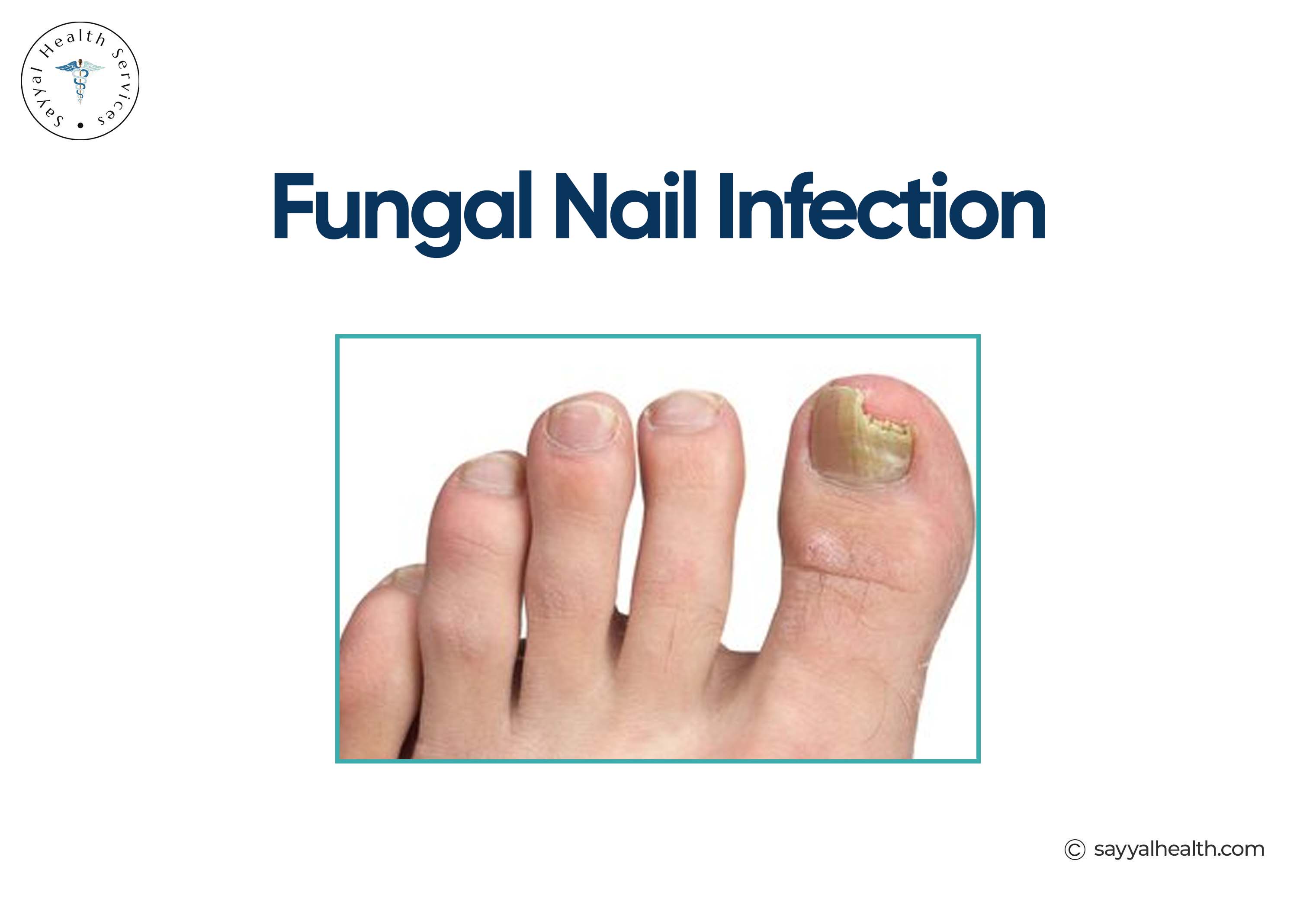 Fungal Nail Infection